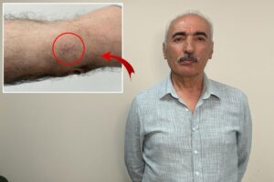 Gri gömlekli yaşlı bir adam ve sol kolda kırmızı daireyle işaretlenmiş küçük leke bulunan yakın plan görsel.