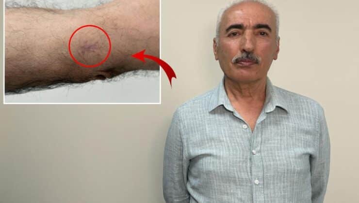 Kolundaki 1 Santimetrelik Yara Kanser Olarak Teşhis Edildi
